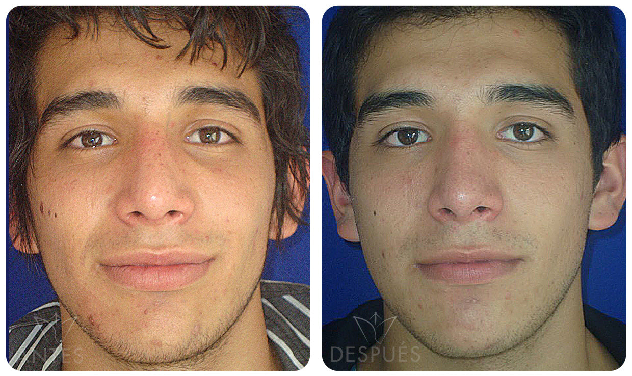 Quiero cotizar una Rinoplastía