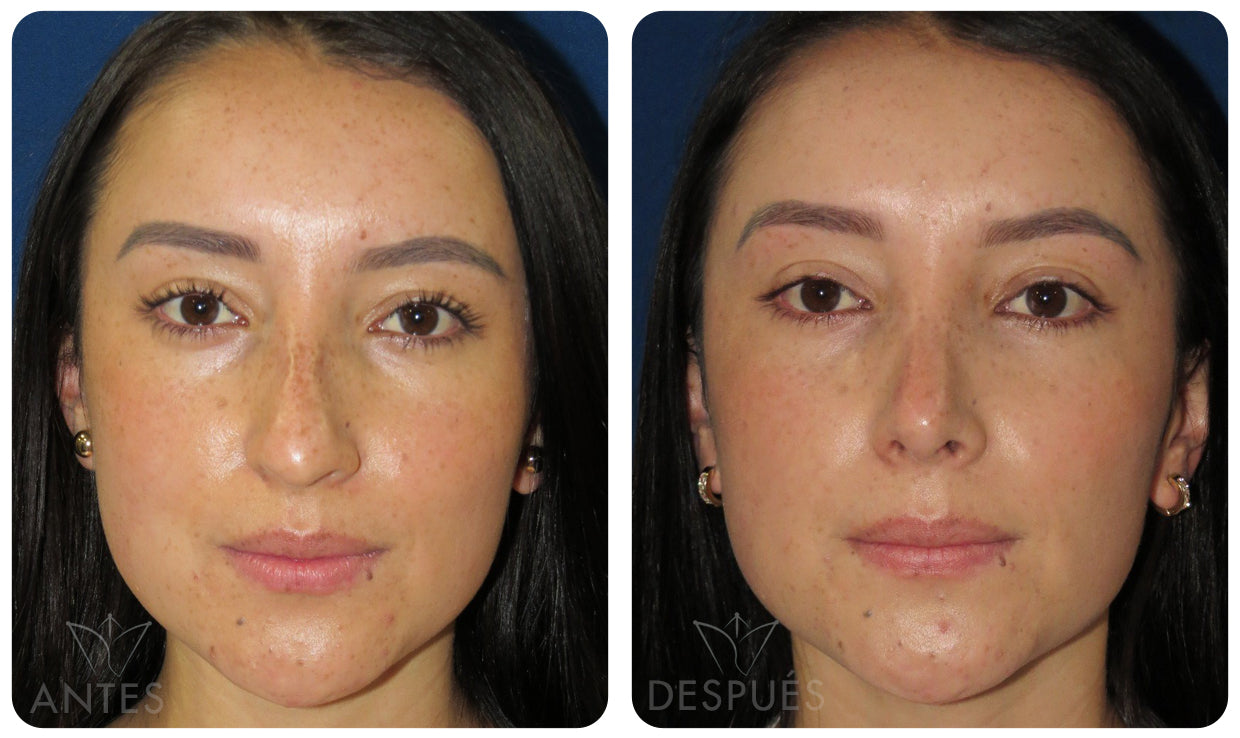 Quiero cotizar una Rinoplastía