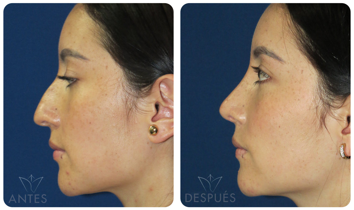 Quiero cotizar una Rinoplastía