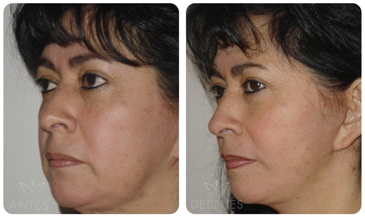 Quiero cotizar una Ritidoplastía