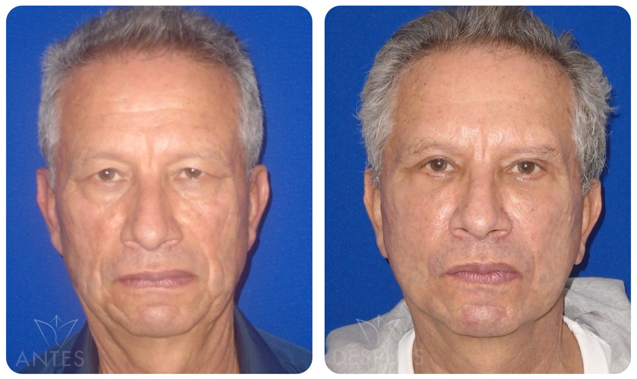 Quiero cotizar una Ritidoplastía