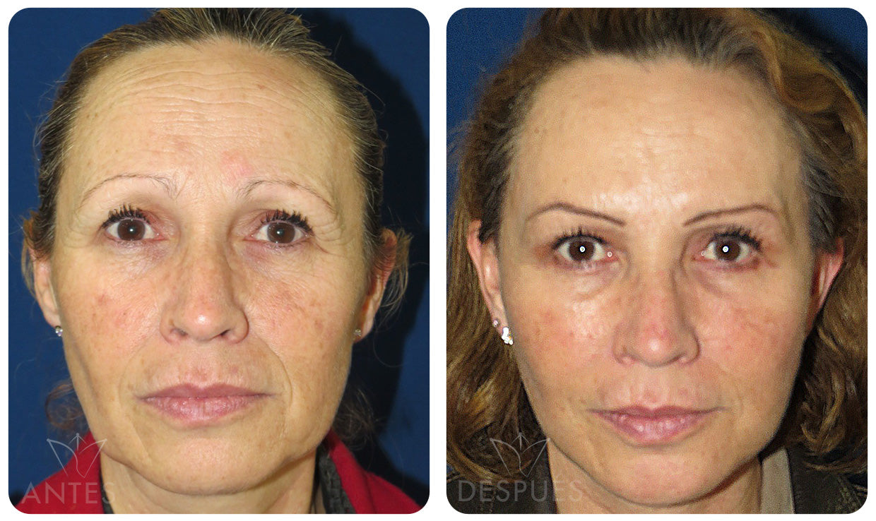 Quiero cotizar una Ritidoplastía