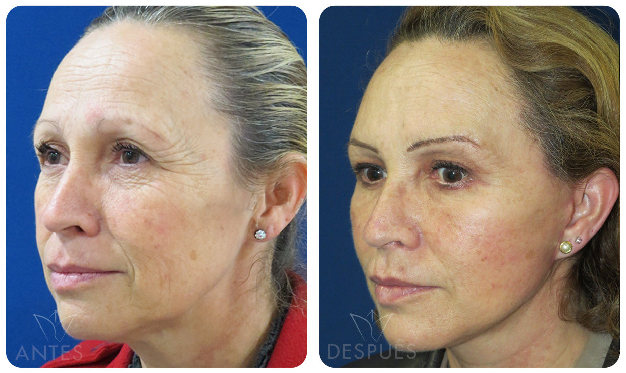 Quiero cotizar una Ritidoplastía