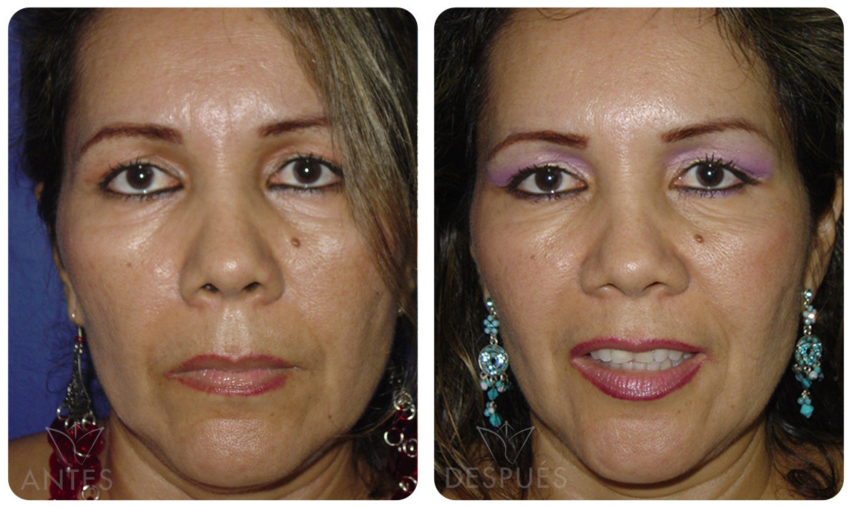 Quiero cotizar una Ritidoplastía