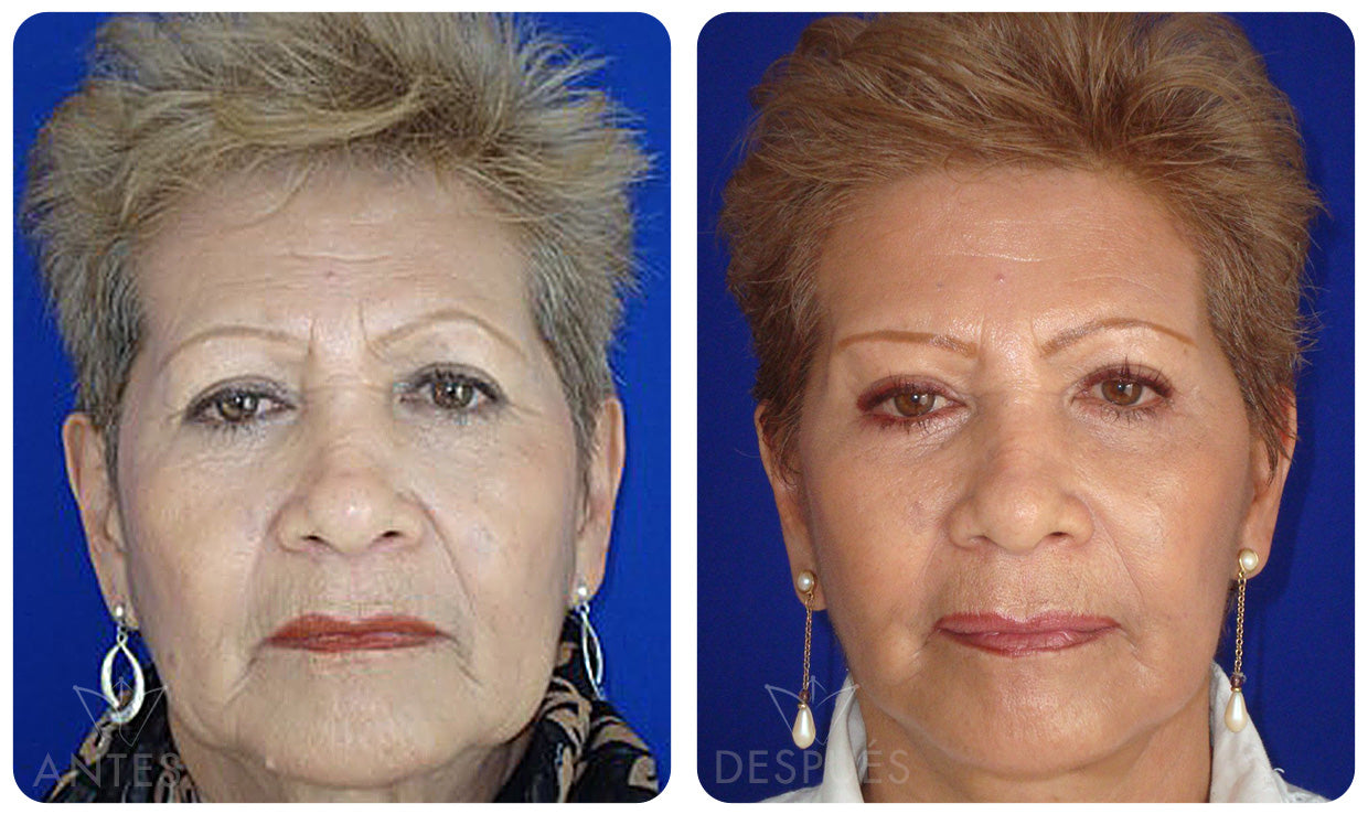 Quiero cotizar una Ritidoplastía