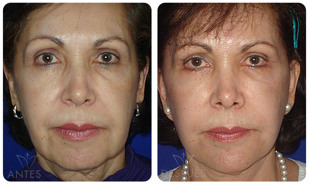 Quiero cotizar una Ritidoplastía