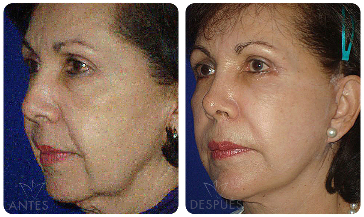 Quiero cotizar una Ritidoplastía