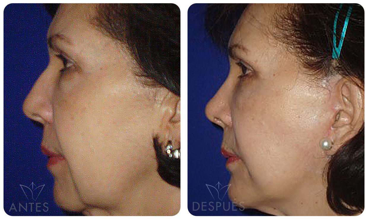 Quiero cotizar una Ritidoplastía