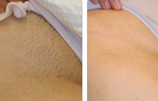 Quiero cotizar un Peeling Laser