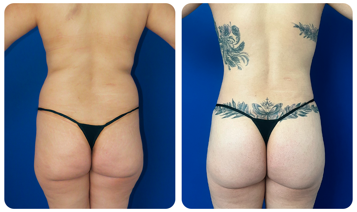 Abdominoplastía