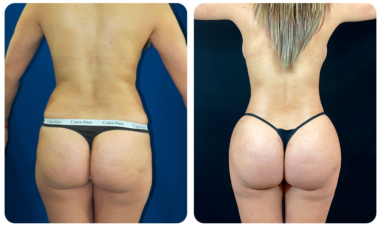 Gluteoplastía