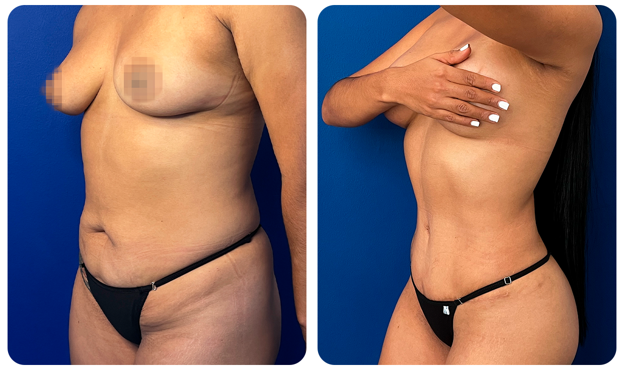 Abdominoplastía