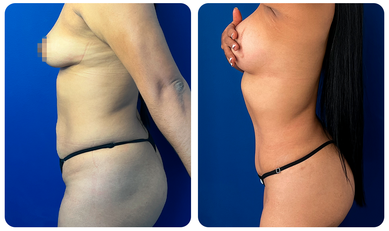 Abdominoplastía
