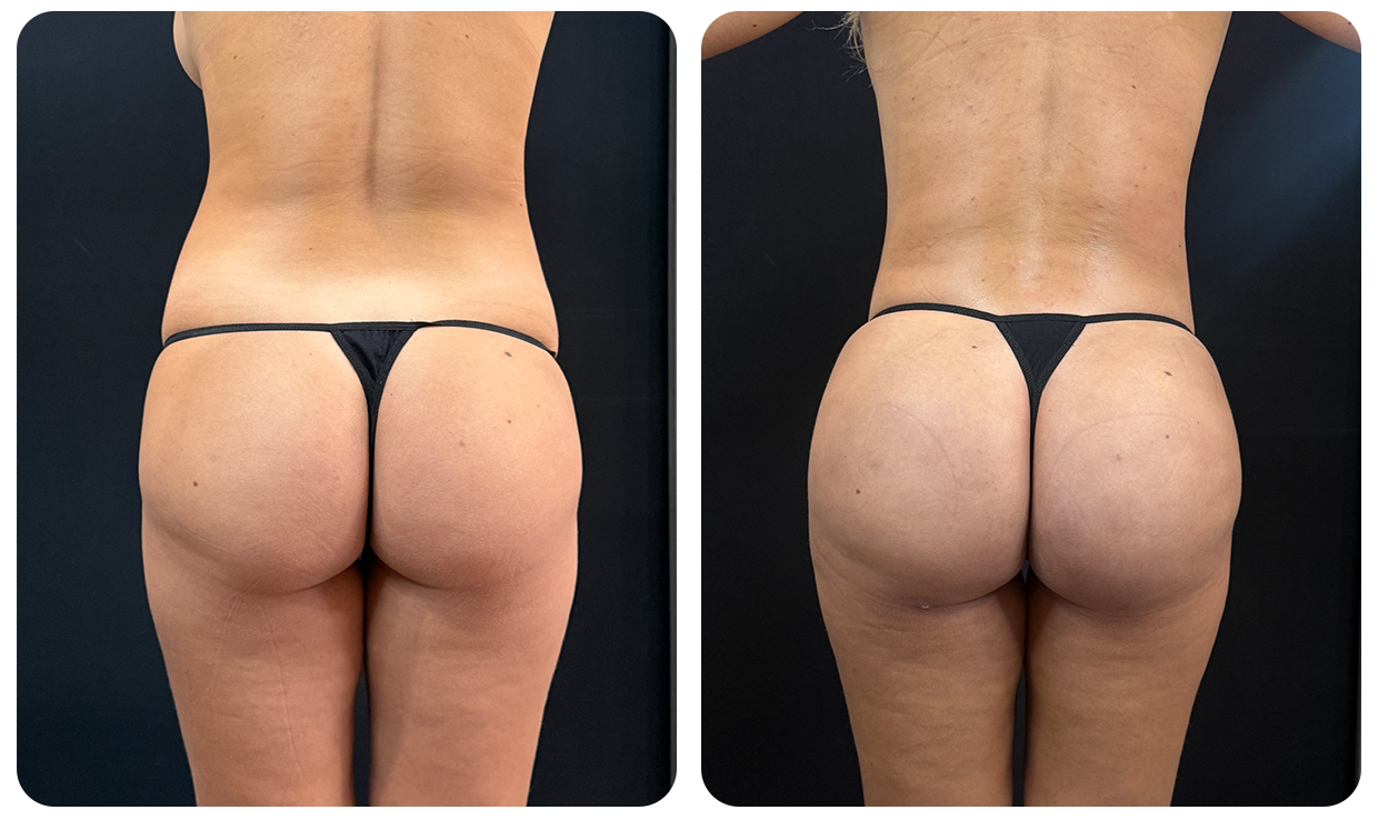 Gluteoplastía