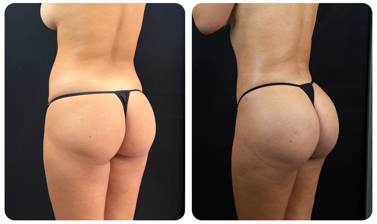 Gluteoplastía